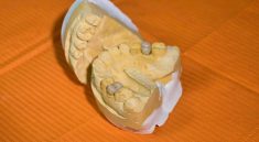 Mold, dental, dentist — Dental Procedures Made Easier With IV Sedation