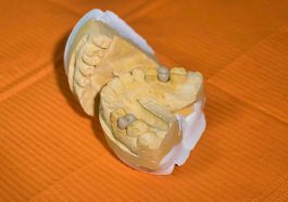 Mold, dental, dentist — Dental Procedures Made Easier With IV Sedation
