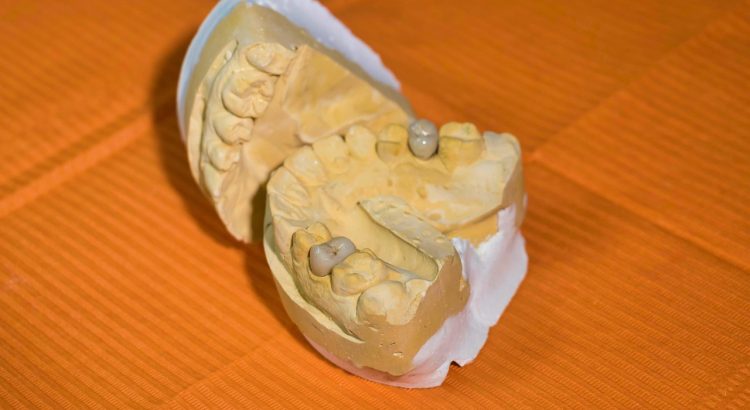 Mold, dental, dentist — Dental Procedures Made Easier With IV Sedation