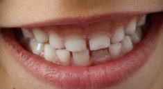 Teeth, child smile, child — The Art of Dental Beautification: Enhancing Your Smile with Modern Techniques