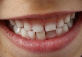 Teeth, child smile, child — The Art of Dental Beautification: Enhancing Your Smile with Modern Techniques
